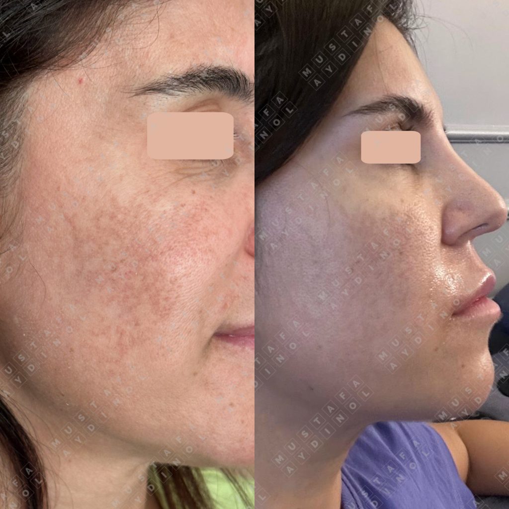 Innesto di nano grasso: si noti il miglioramento della texture e del tono della pelle e delle rughe sottili in una sola sessione. Il paziente era soddisfatto e non ha richiesto una seconda sessione.