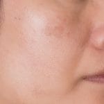 Skin texture before and after skin care