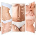 mommy makeover