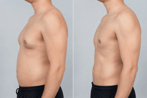 ginecomastia, redução mamária masculina