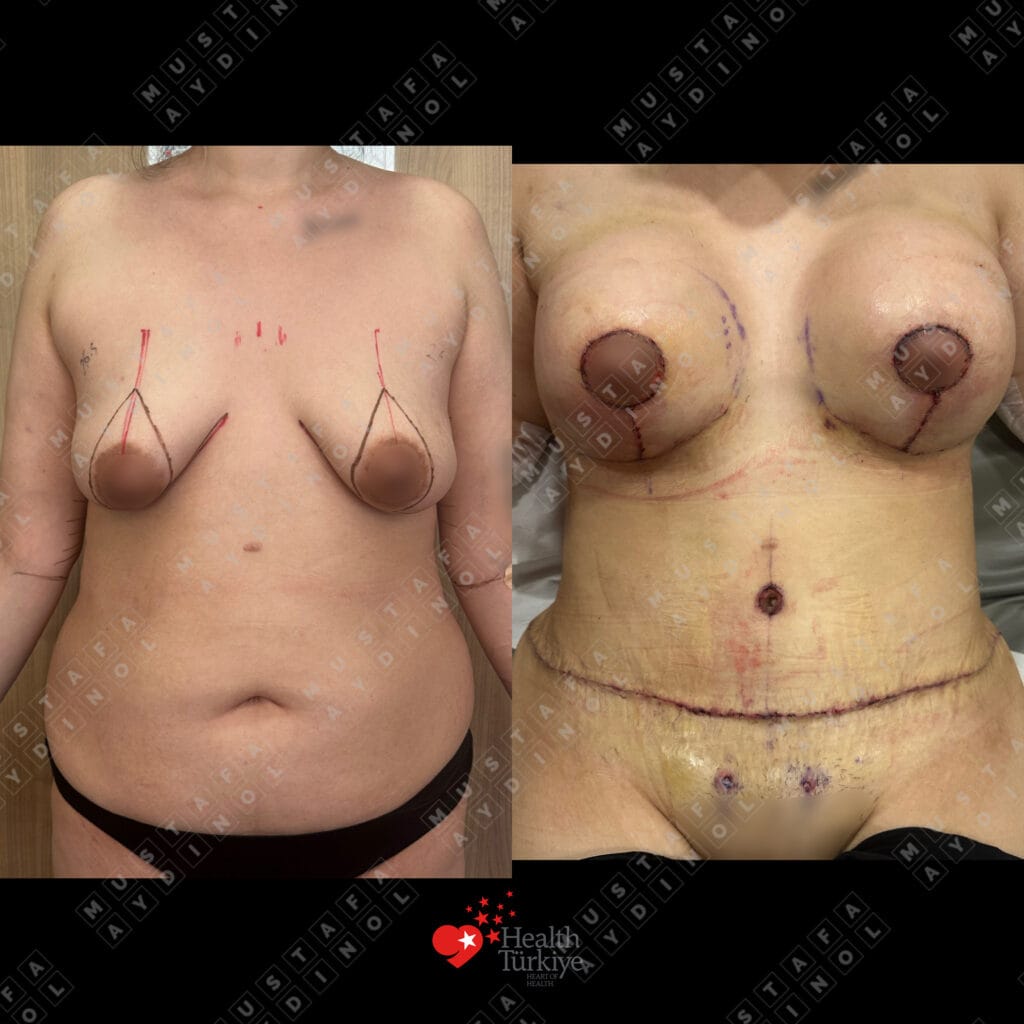 28 yaşında 30 kg kilo kaybı sonrası anne estetiği: karın germe, implantlı meme dikleştirme, liposuction ve BBL, ameliyat öncesi ve bir hafta sonrası