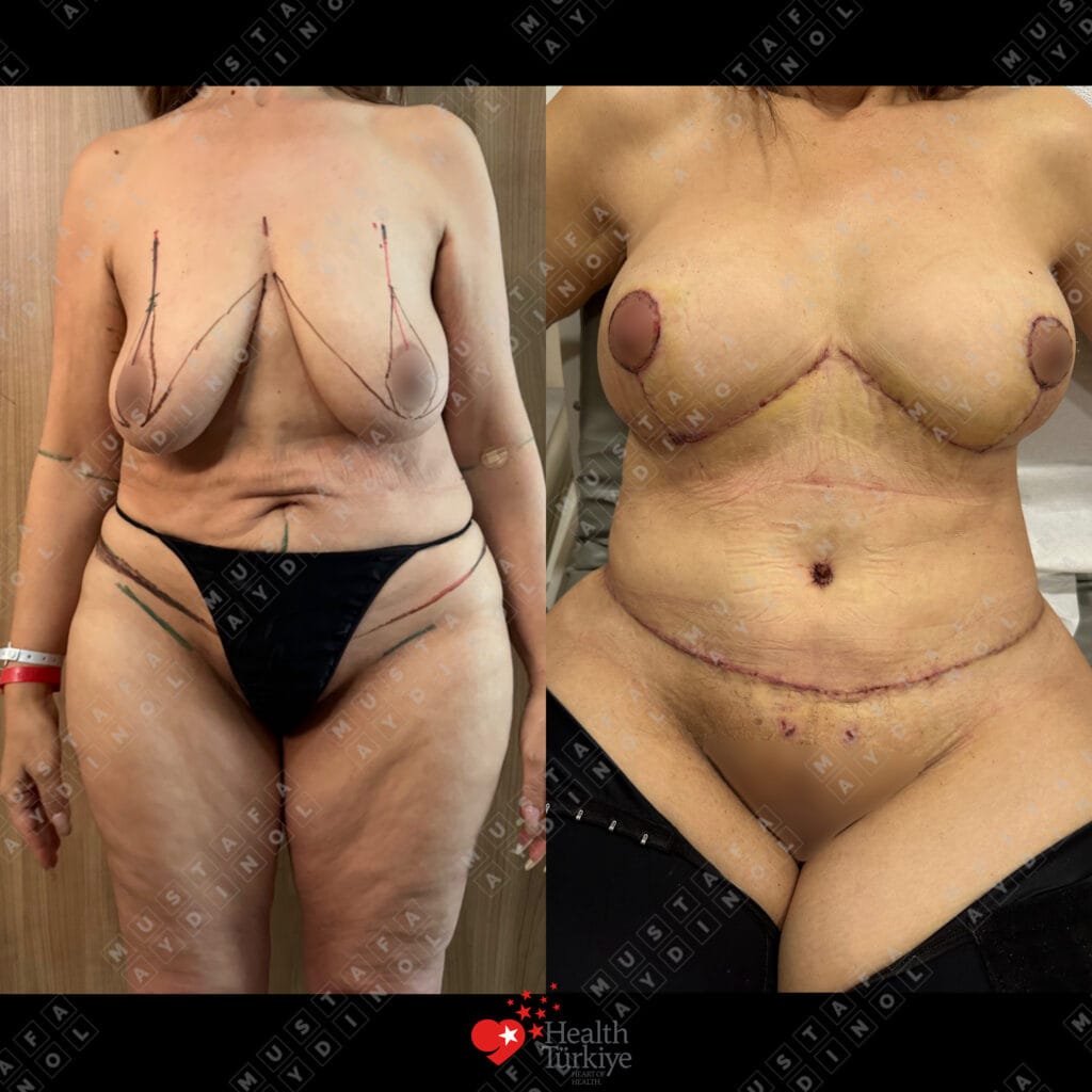 60 yaşındaki bir hastada implantsız meme dikleştirme, karın germe, 360 liposuction ve BBL: ameliyat öncesi ve bir hafta sonrası