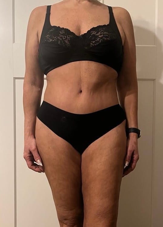 Mommy makeover after surgery: front view in underwear showing the abdomen and waistline after tummy tuck and VASER liposuction