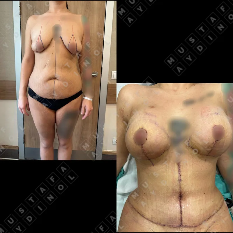 Loose skin, removed in one plan, Fleur-de-Lys, before