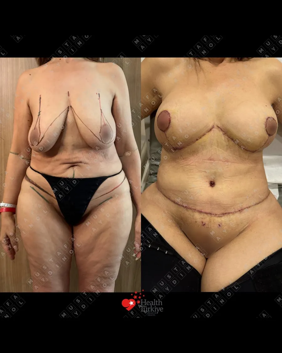 Breast lift, tummy tuck, 360 liposuction and BBL