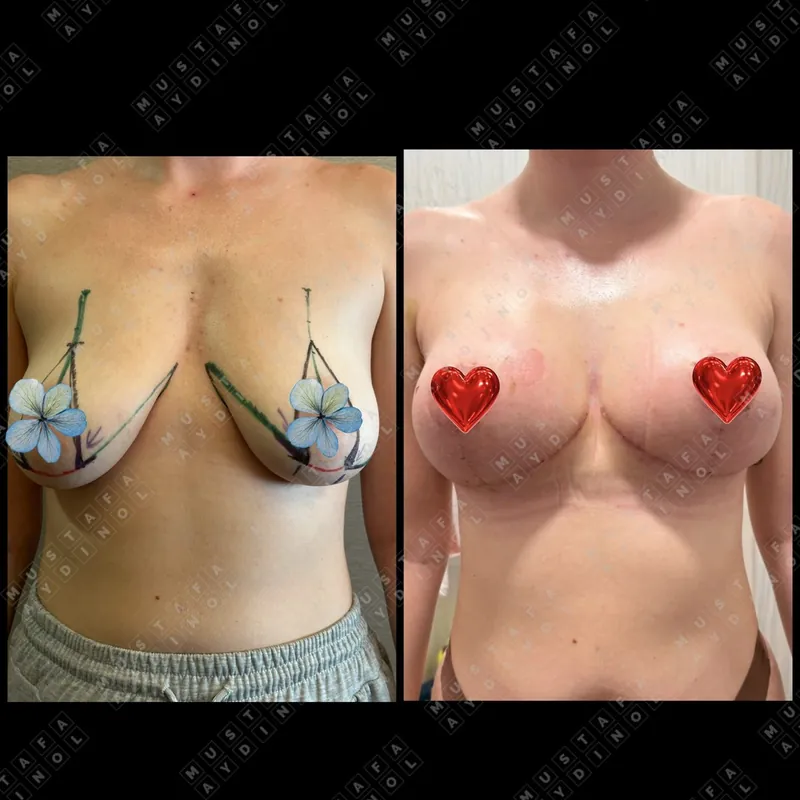 Three different operations, Lift with implants
