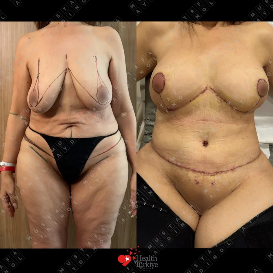 Breast lift without implants