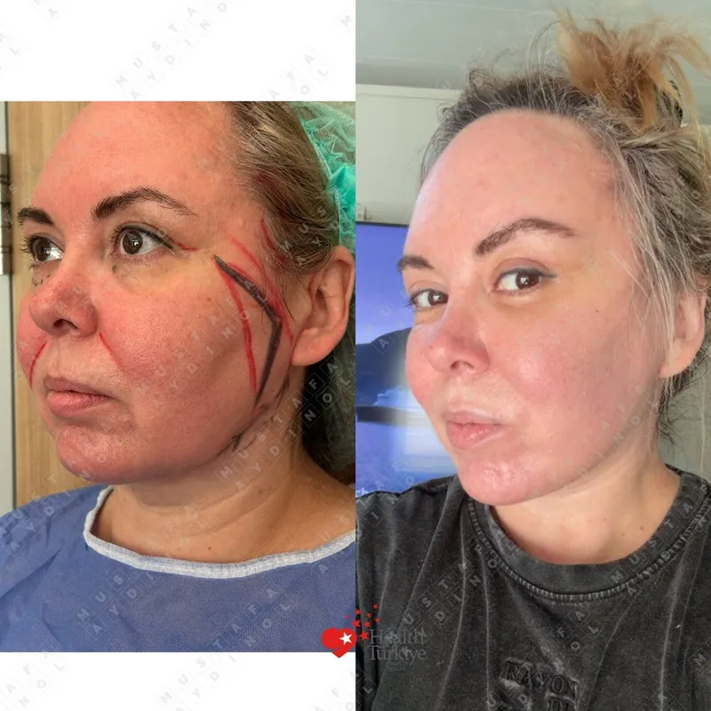 Facelift, Oblique