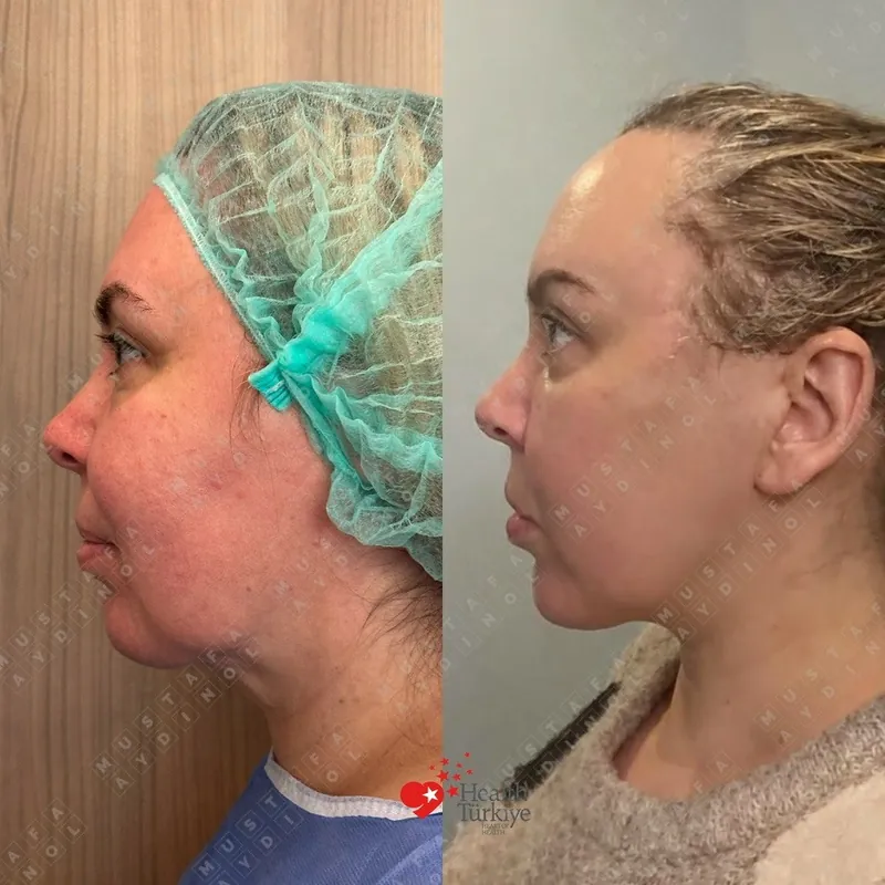 Facelift, Profile