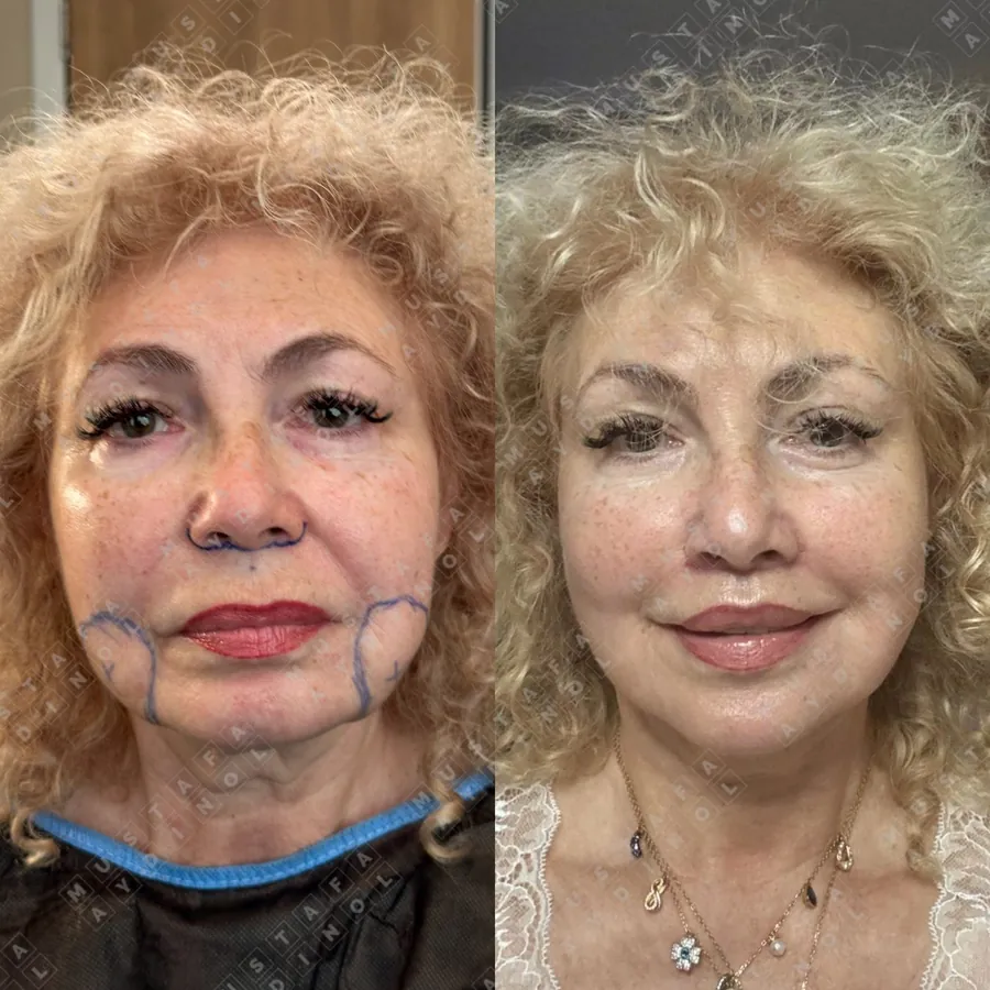 Deep plane facelift, neck lift and lip lift