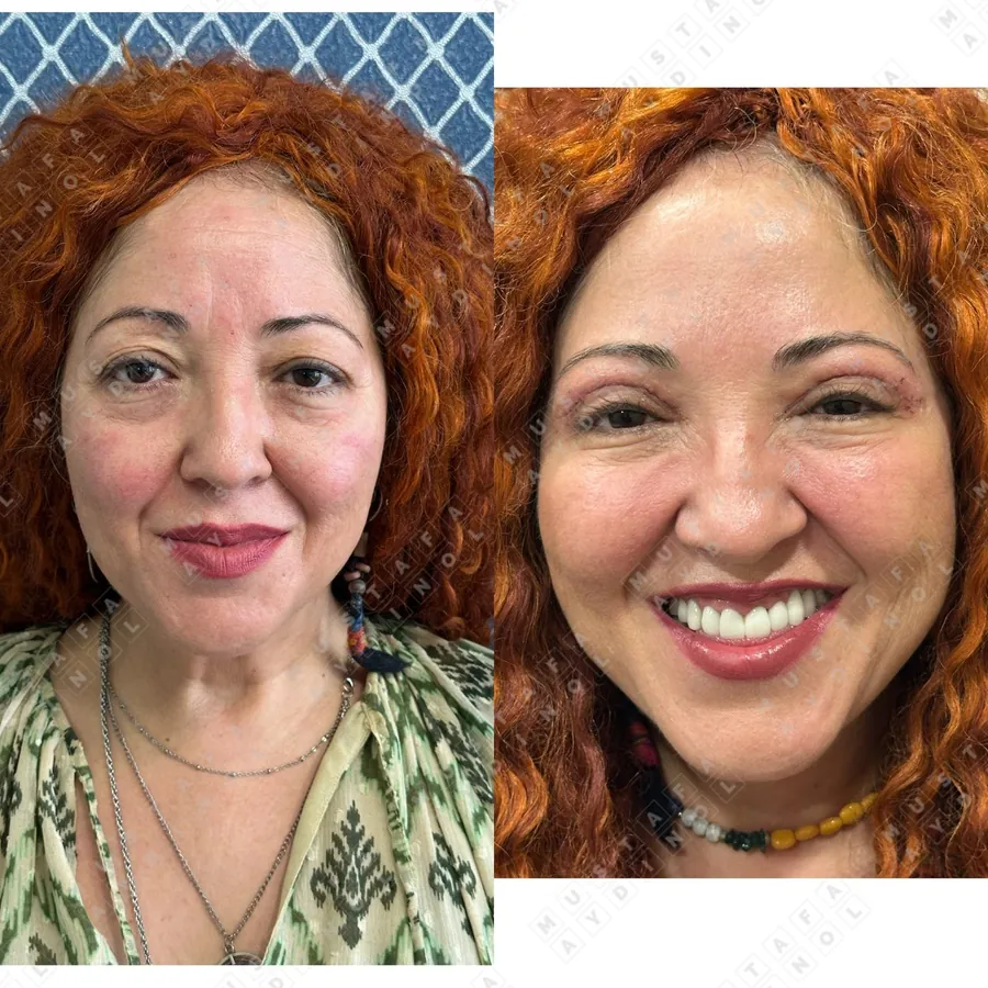 Blepharoplasty, Botox and Fotona 4D laser