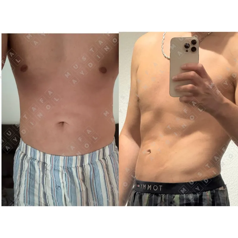 Three different areas, Male HD liposuction