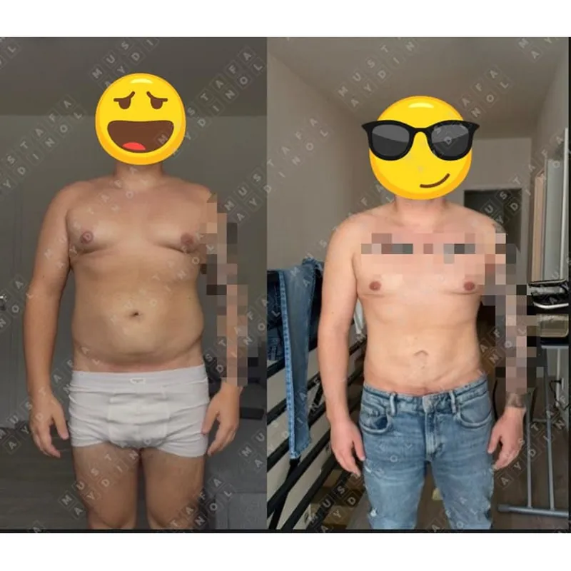 Three different areas, Lipo and chest