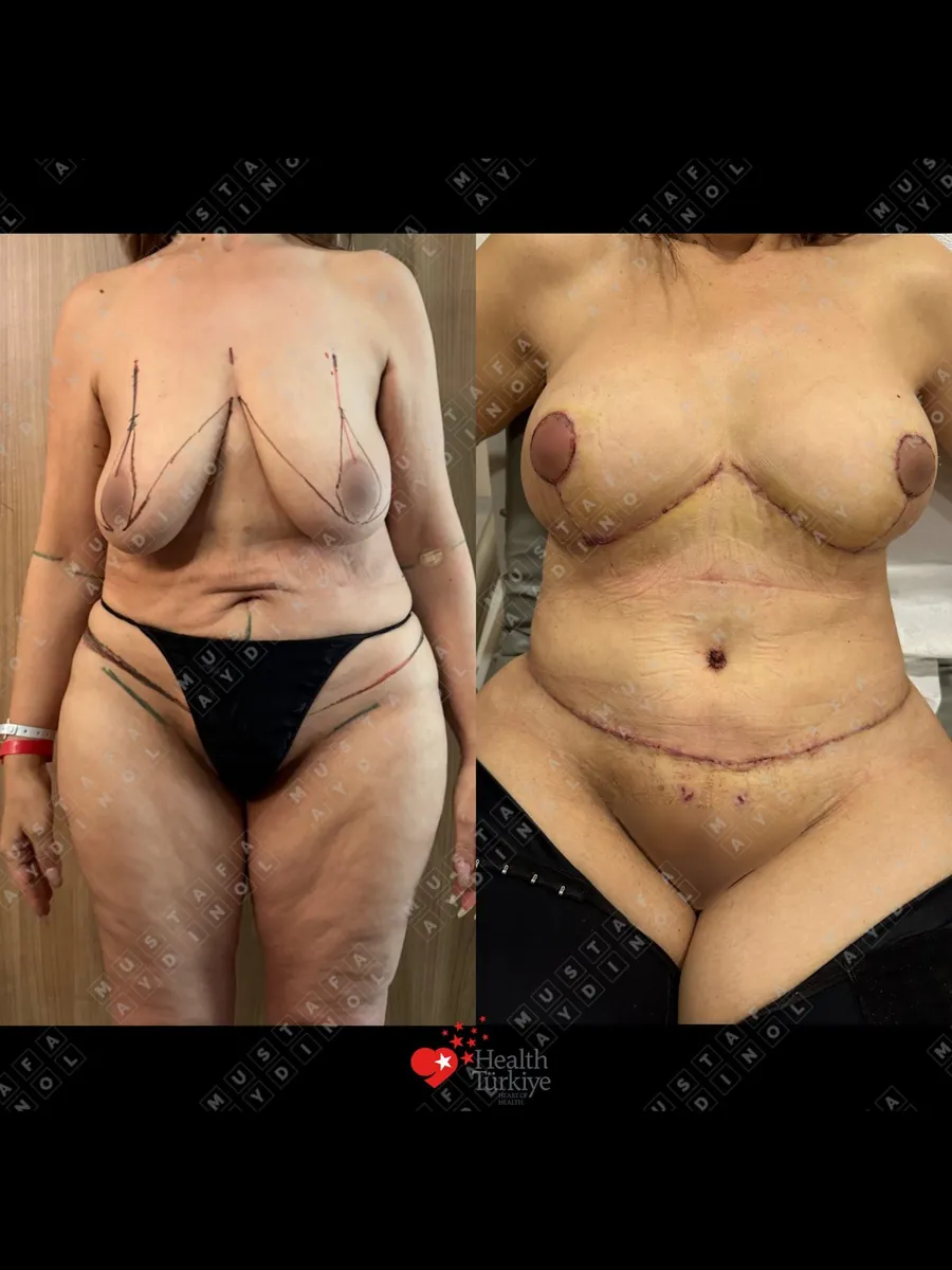 360 liposuction and BBL