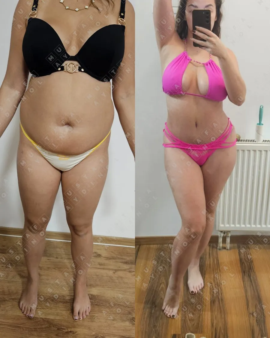 Liposuction, abdominoplasty and BBL
