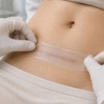 Silicone gel sheet on a healed surgical scar, scar care after plastic surgery
